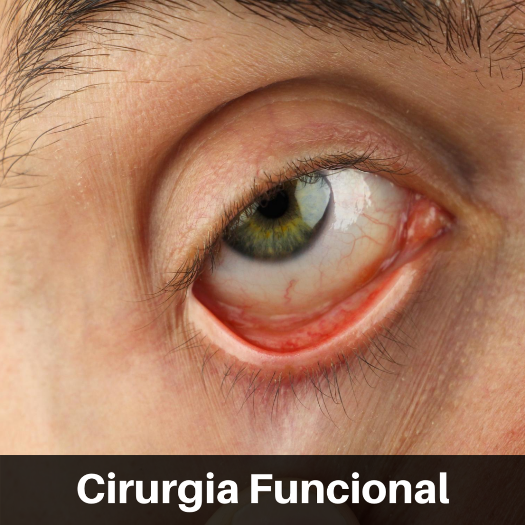 Cirurgia ocular funcional